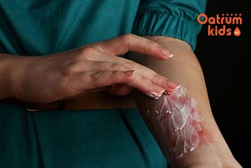 Điều trị bỏng nước sôi tại nhà cần tuân theo chỉ dẫn của bác sĩ