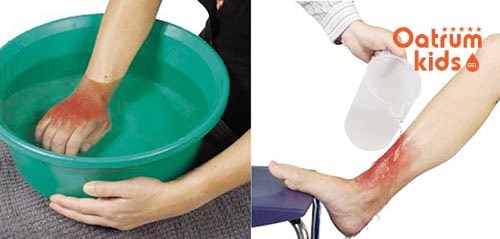 Thời điểm “vàng” để làm mát vết bỏng đó là thực hiện ngay khi bị bỏng