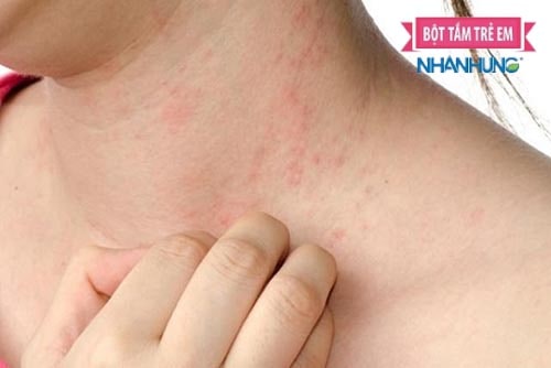 Các triệu chứng ban đầu của viêm da cơ địa