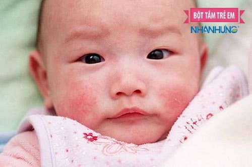 Mặc quần áo quá kín, để da quá khô, dị ứng xà phòng… là những nguyên nhân khiến trẻ bị viêm da cơ địa nặng thêm.