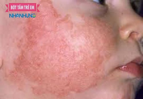 Hình ảnh viêm da cơ địa ở trẻ - 1