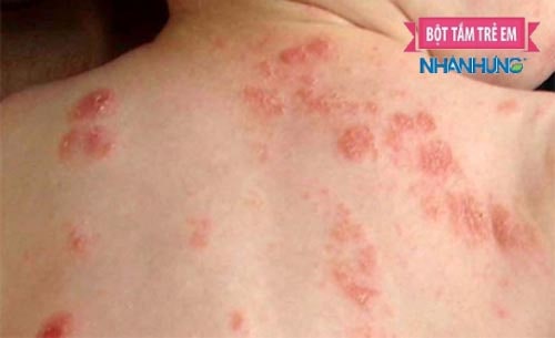 Hình ảnh viêm da cơ địa ở trẻ -2