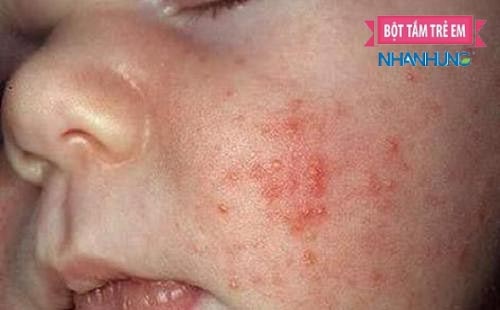 Hình ảnh viêm da cơ địa ở trẻ - 3
