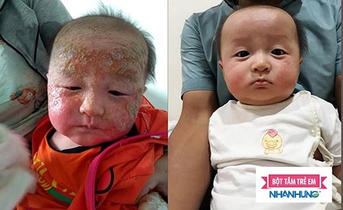 Hình ảnh viêm da cơ địa ở trẻ - 5