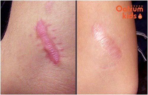 Điều trị bỏng bô xe máy không đúng cách có thể để lại sẹo xấu trên da