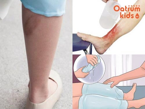 Sơ cứu bỏng bô xe máy đúng cách sẽ hạn chế nguy cơ để lại sẹo