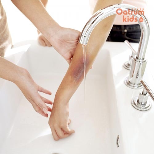 Rửa sạch vết thương dưới vòi nước để chống nhiễm khuẩn