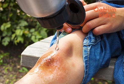 Cần rửa sạch vết trầy xước, rách da ở trẻ