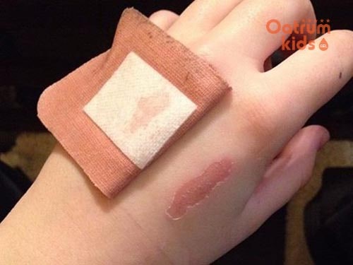 Thay băng thường xuyên để giúp vết trầy xước mau phục hồi