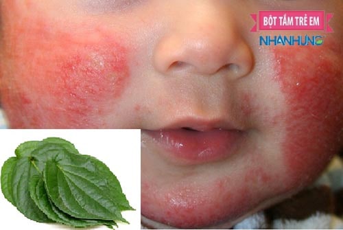 Bài thuốc viêm da cơ địa từ lá trầu không