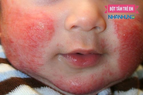 Viêm da cơ địa ở trẻ nhỏ với biểu hiện da khô, sần, mẩn đỏ