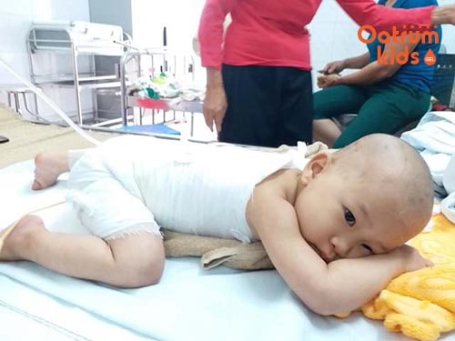 Trẻ bị bỏng nước sôi là tai nạn nghiêm trọng