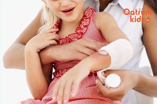 Băng bó vết bỏng cho trẻ để ngăn ngừa vi khuẩn xâm nhập