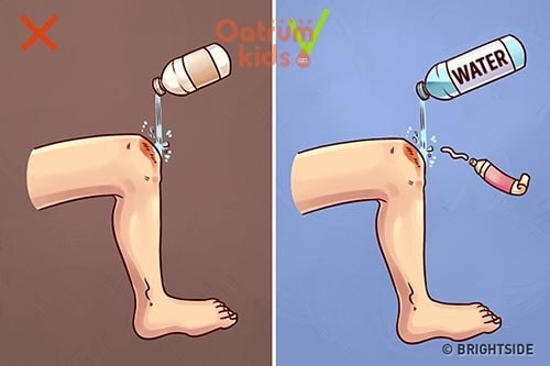 Chỉ dùng nước mát sơ cứu vết bỏng, tuyệt đối không dùng nước đá