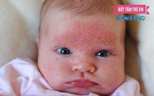 Viêm da cơ địa là bệnh mạn tính, xuất hiện ở trẻ với nhiều nguyên nhân khác nhau.