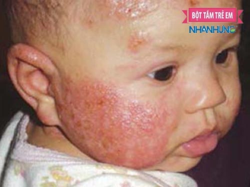 Viêm da cơ địa là bệnh mạn tính ở trẻ nhỏ và có tính di truyền