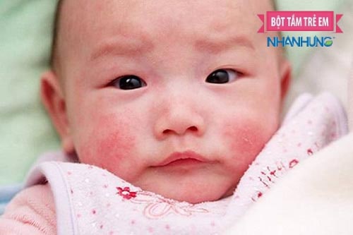 Viêm da cơ địa có thể khiến bé mệt mỏi, chán ăn, quấy khóc, sốt nhẹ.