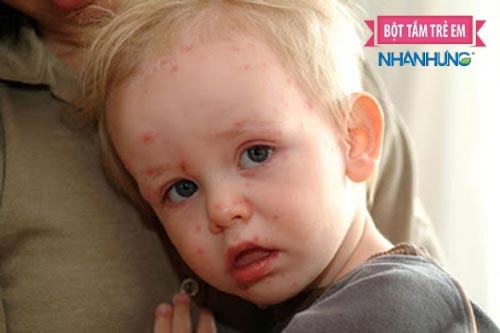 Viêm da cơ địa có tính di truyền cao