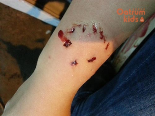 Hệ miễn dịch yếu là căn nguyên khiến trẻ dễ bị nhiễm trùng