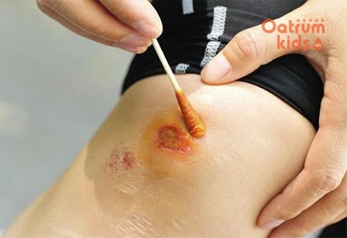 Bôi gel có tác dụng kháng khuẩn giúp liền da nhanh