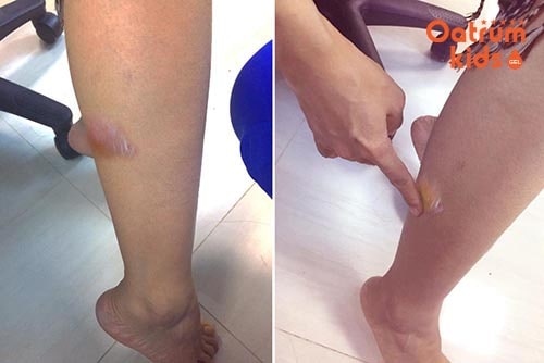 Khi bỏng bô xe máy có bọng nước không nên tự ý chọc thủng