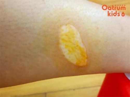 Khi bọng nước bị vỡ cần chăm sóc cẩn thận tránh để lại sẹo trên da