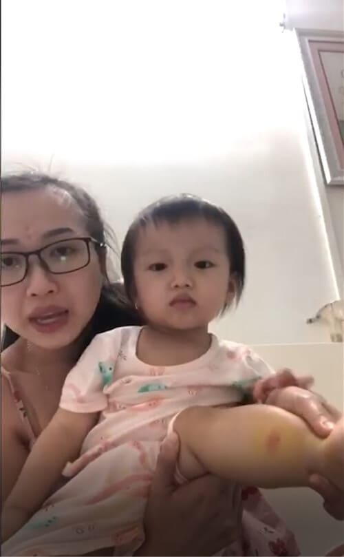 Mỗi lần bị muỗi đốt là y như rằng làn da của bé Nhi lại sưng đỏ rất to