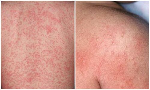Rôm sảy có thể tái phát nhiều lần nếu không điều trị triệt để