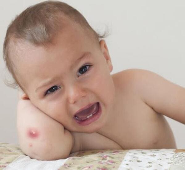 Oatrum Kids New giúp trị mụn nhọt ở trẻ nhanh chóng