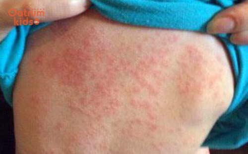 Rất nhiều trẻ bị rôm sảy ở lưng