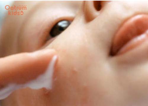 Cẩn trọng khi sử dụng các loại kem bôi trị rôm sảy cho bé