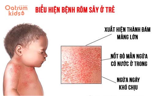 Rôm sảy ở trẻ thường xuất hiện nhiều vào thời tiết nóng nực