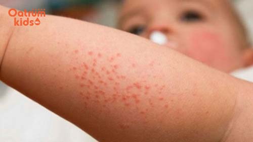 Rôm sảy có thể mọc ở khắp các cơ thể trẻ