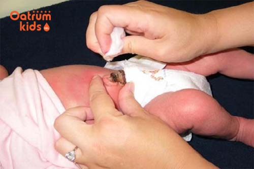  Dấu hiệu bất thường ở rốn trẻ sơ sinh