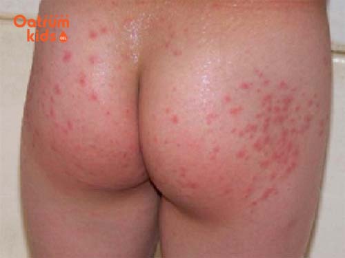  Trẻ nổi mụn nước ở mông do nhiều nguyên nhân khác nhau