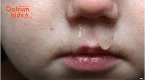  Trẻ sơ sinh rất dễ bị bệnh viêm tai giữa