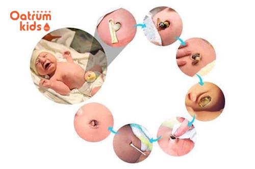  Quá trình rụng rốn, lành vết thương ở trẻ sơ sinh