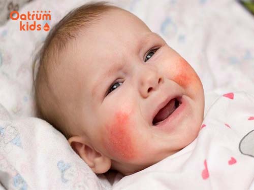  Khi bị nổi mụn nước, trẻ sơ sinh sẽ khó chịu và quấy khóc