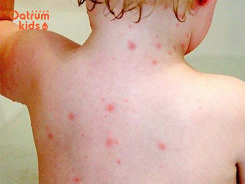  Côn trùng đốt, bị bỏng, virus… là những nguyên nhân khiến trẻ sơ sinh nổi mụn nước