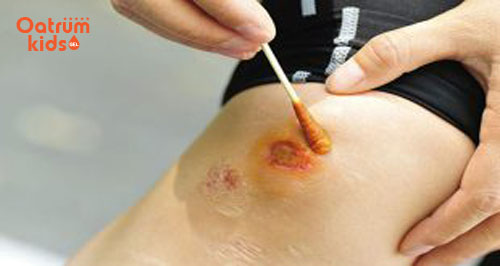 Vết trầy xước da ở trẻ rất dễ bị chảy nước, mưng mủ