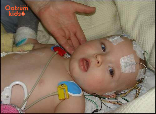 Trẻ có thể bị viêm màng não vì vết trầy xước ở đầu gối