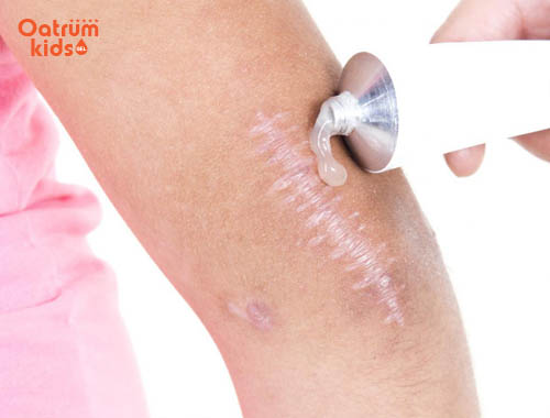 Thuốc mỡ kháng sinh có thể gây kích ứng, mẩn đỏ