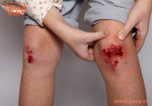 Vết trầy xước lâu lành có thể do nhiễm trùng