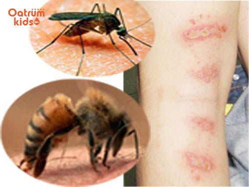 Côn trùng cắn gây ra vết thương rách da ở trẻ