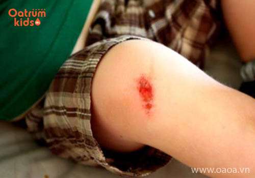 Trầy xước da ở trẻ là điều khó có thể tránh khỏi
