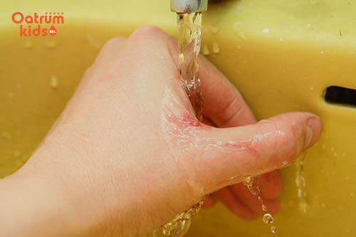 Chỉ nên rửa vết rách da bằng nước sạch