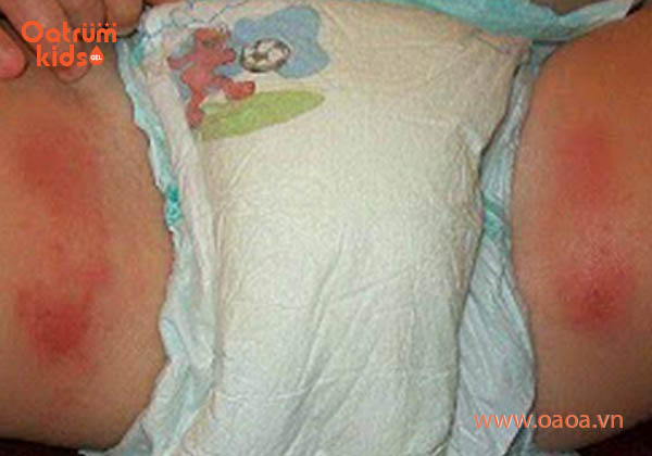 Rất nhiều trẻ bị hăm bẹn “tấn công”