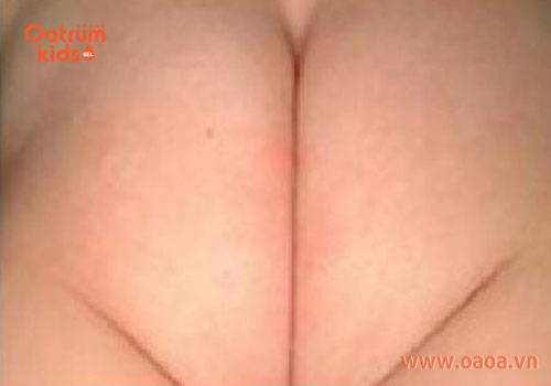 Cấp độ 2: vết ửng đỏ xuất hiện trên da nhiều hơn
