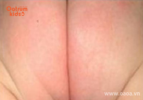 Cấp độ 3: trên da xuất hiện những vết ửng đỏ với diện tích lớn hơn