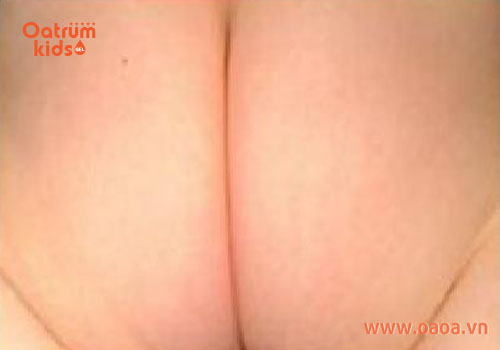 Cấp độ 1: da bé có màu ửng hồng ở diện tích nhỏ